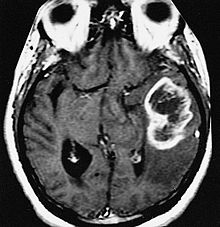 Qué es el glioblastoma